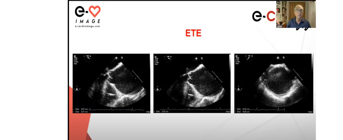 Repaso de Modulo de Aorta con Arturo Evangelista