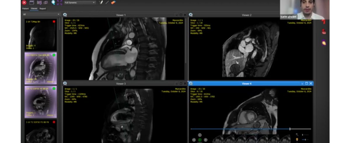 Sesión de post-procesado on line del Curso de Resonancia Magnética Cardiaca.
